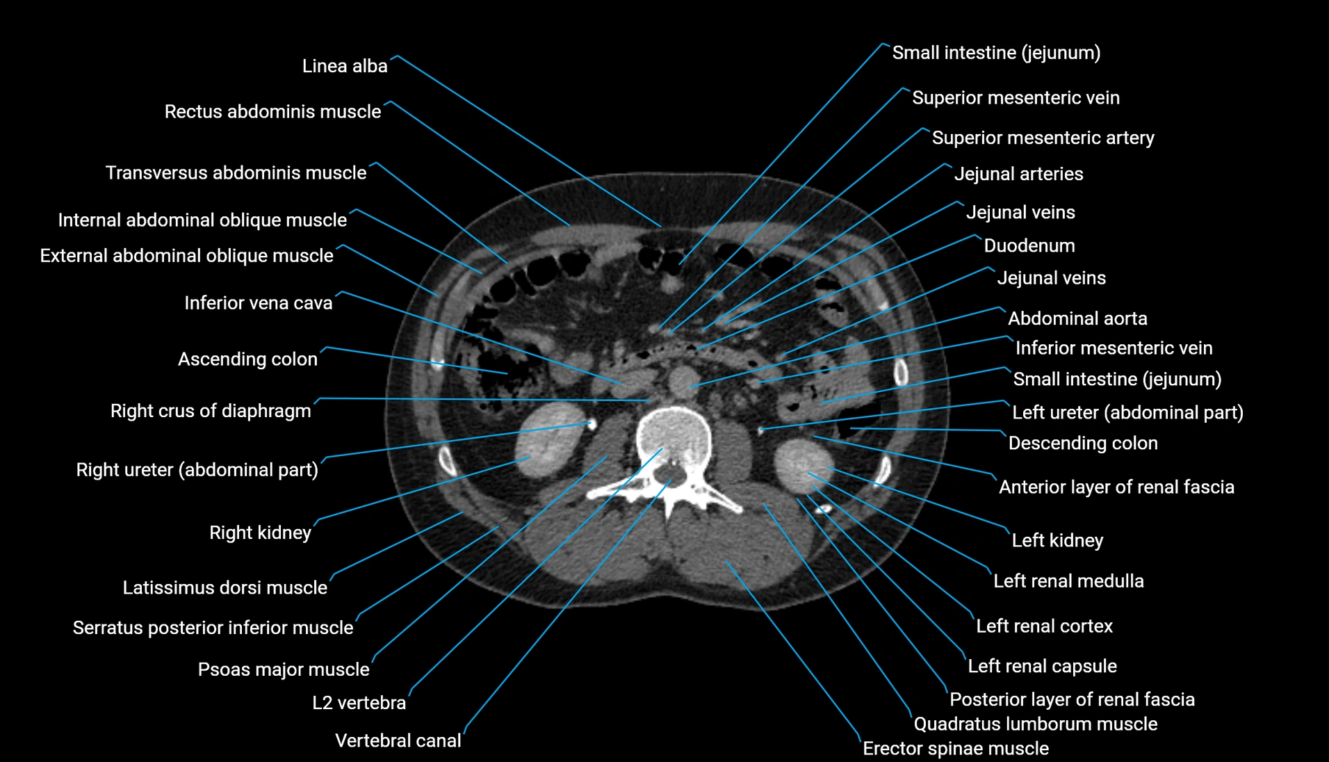 CT urogram axial cross sectional anatomy  labelled radiology image-00116.webp